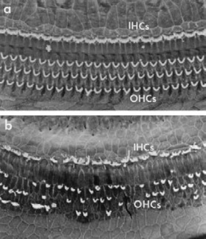 Poškození vnitřních i zevních vláskových buněk
v elektronovém mikroskopu (podle: Ryan et al., 10)
a – normální stav; b – poškozené vláskové buňky; IHCs –
vnitřní vláskové buňky; OHCs – zevní vláskové buňky.