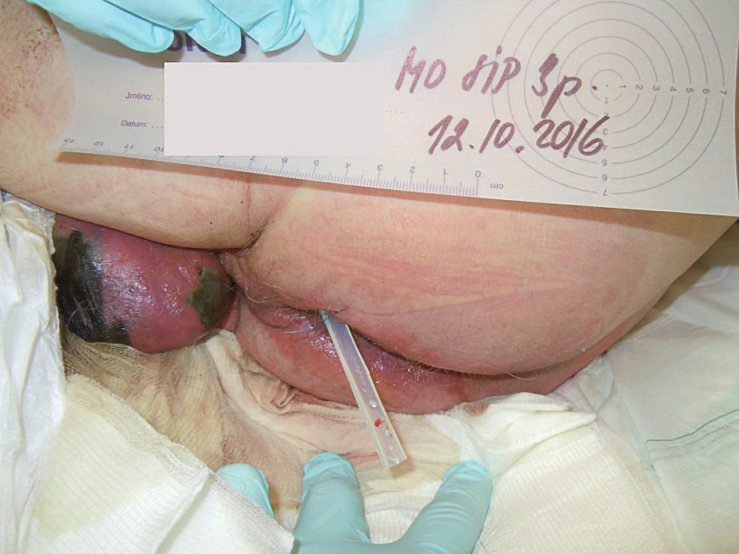 Klinický obraz Fournierovy gangrény při přijetí, postižení
v celé tloušťce kožního krytu skrota, indurace a zarudnutí
pararektálně