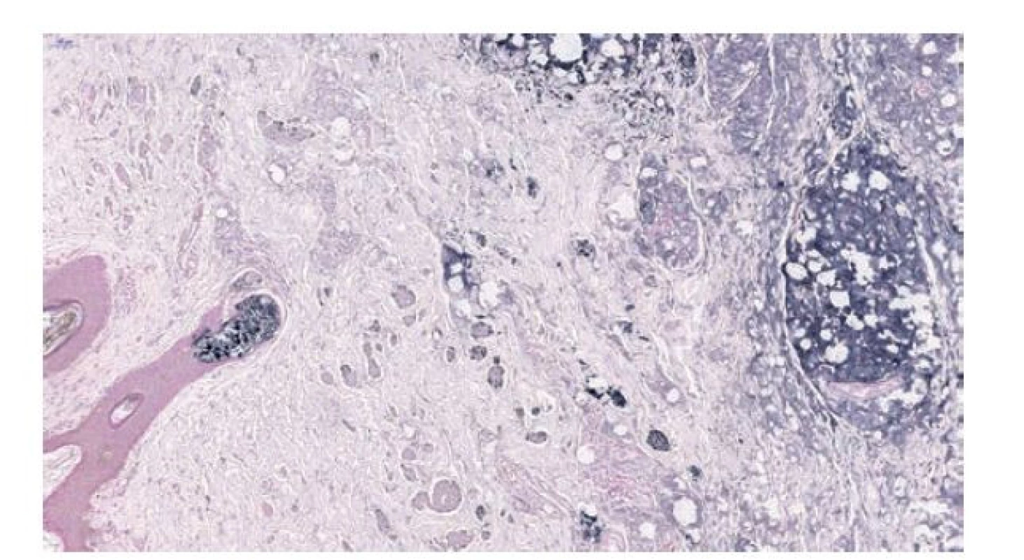 Histologie zmraženého řezu v barvení Sudanem, které barví černě
makrofágy obsahující kapénky parafínu (vpravo), myelinizované nervy
(uprostřed) a mazové žlázky (vlevo). 8.2x.