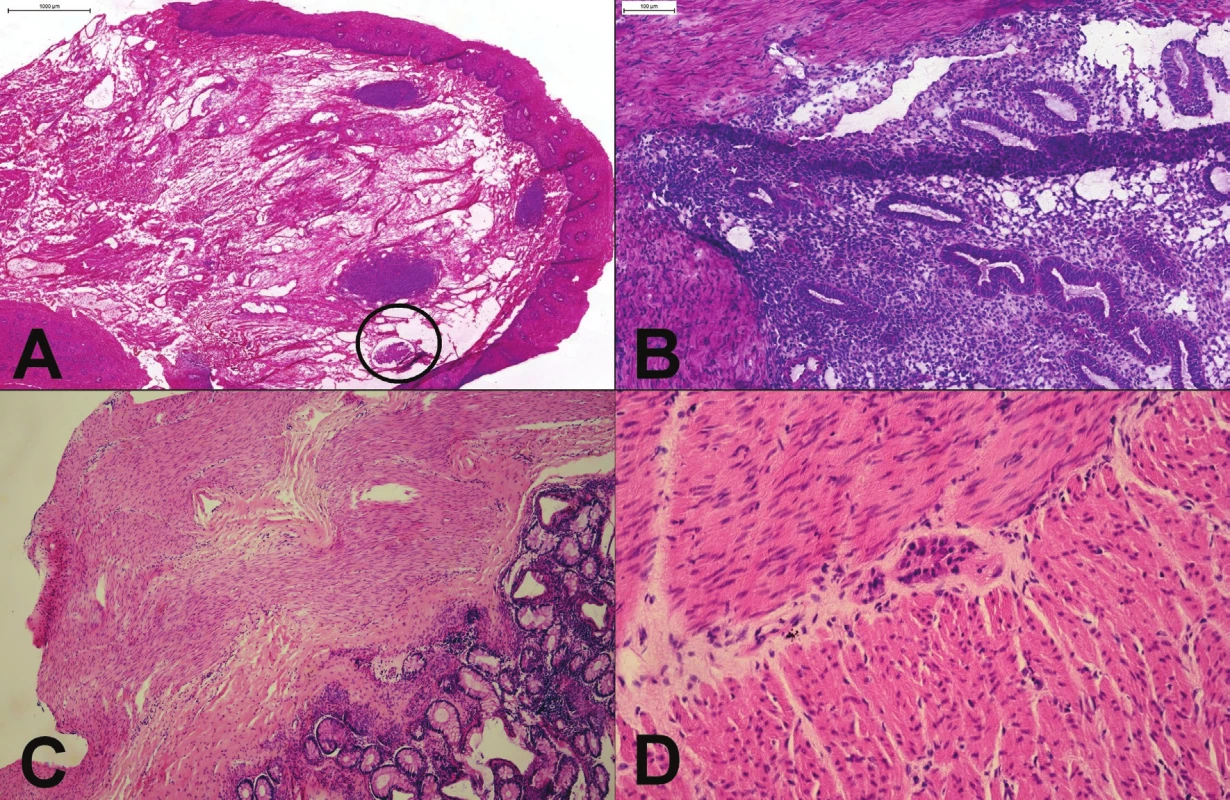 (A) Proximálny resekčný okraj resekátu adenokarcinómu ezofago-gastrickej junkcie. Slizničný povrch bol makroskopicky
aj mikroskopicky „čistý“, v kapilárach lamina propria však boli zachytené zhluky nádorových buniek (v krúžku). (B) Tumor rekta
u 25 ročnej ženy. Mikroskopicky boli zachytené mitoticky aktívne, mierne „atypické“ žliazky, vzdialene pripomínajúce kolorektálny
adenokarcinóm. Kľúčom k správnej diagnóze endometriózy je rozpoznanie endometriálnej strómy. (C) Hirschprungova choroba:
chýbanie gangliových buniek v plexus submucosus a myentericus. (D) Imatúrne gangliové bunky v plexus myentericus.