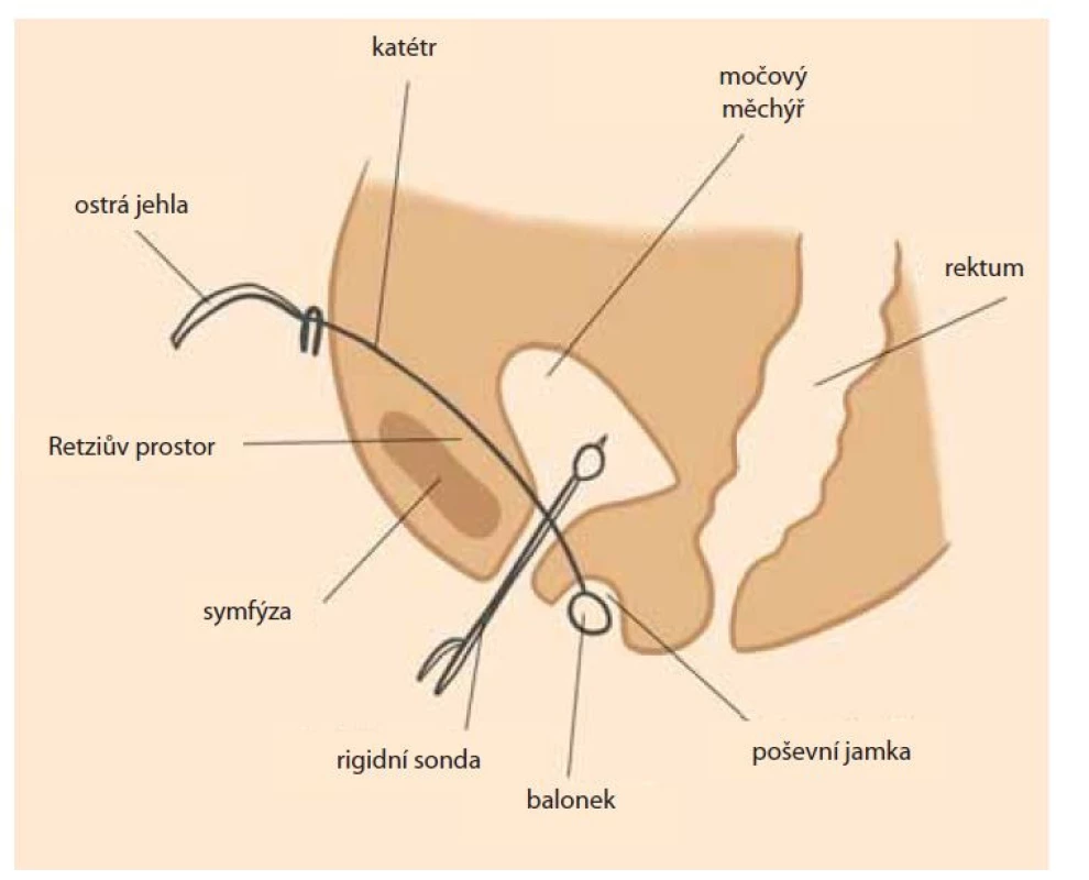 Retropubická balonková vaginoplastika.<br>
Fig. 2. Retropubic balloon vaginoplasty.