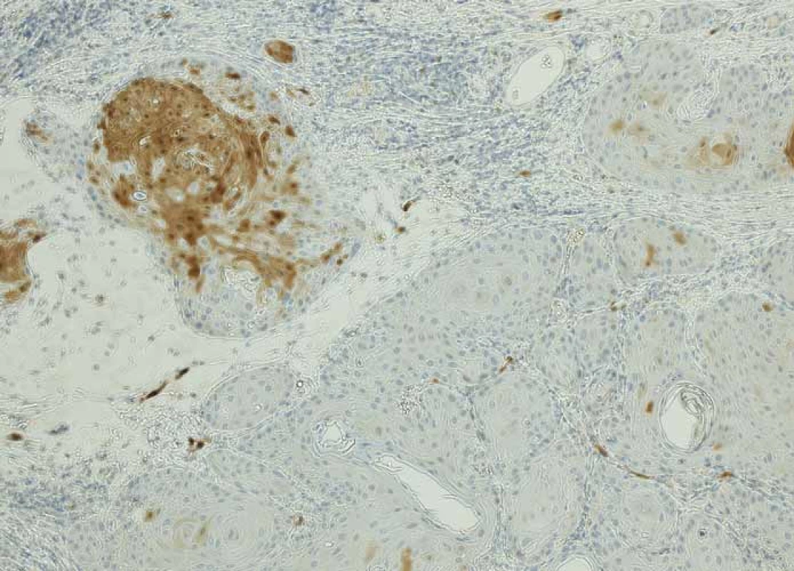p16− dlaždicobuněčný karcinom orofaryngu – ložisková slabá až střední exprese
v méně než 70 % nádorových buněk, zvětšení 100×.