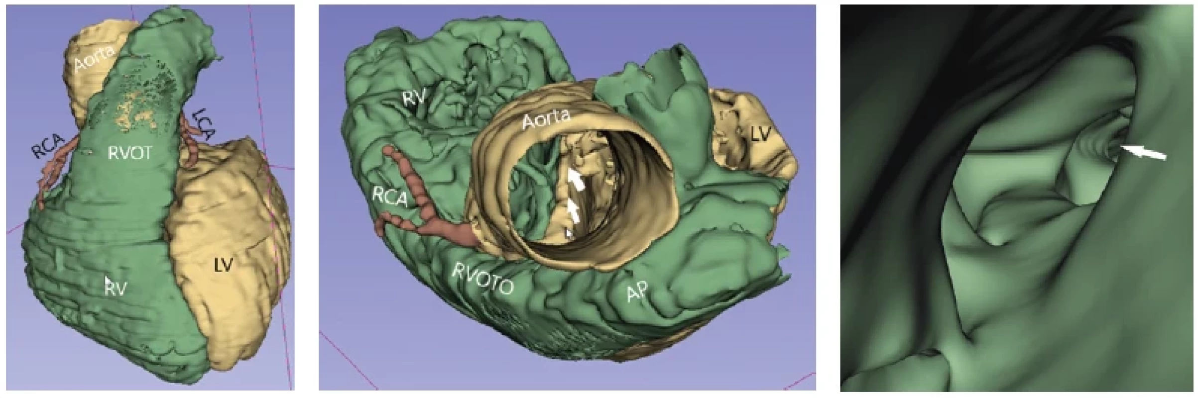 3D virtuálny „reálny“ model extra- aj intrakardiálnych štruktúr u 9-ročného pacienta klinicky sa manifestujúceho centrálnou cyanózou.
Išlo o pacienta s echokardiograficky diagnostikovanou Fallotovou tetralógiou. 3D model bol indikovaný na zobrazenie výtokového
traktu pravej komory (RVOT) a zobrazenie koronárnych artérií s cieľom vylúčenia priebehu ramus interventricularis anterior pred RVOT
(takýto nález kontraindikuje realizáciu transanulárnej záplaty cez pľúcnu chlopňu v rámci kompletnej chirurgickej korekcie chyby). Obrázok
vľavo: anteriórny pohľad. Zobrazené normálne odstupy a priebehy koronárnych artérií. Stredný obrázok: pohľad zhora. Cez ascendentnú
aortu pri pohľade nadol do srdca je vidieť hornú hranu medzikomorového septa (zobrazená bielymi šípkami), nad ktorou sa nachádza defekt
komorového septa, kedže pri pohľade z aorty je vidieť do oboch srdcových komôr. Zároveň sa vizualizuje užší výtokový trakt pravej komory
(RVOTO). Obrázok vpravo: detailný pohľad do stenotického RVOTO z pľúcnice (pohľad zhora nadol), v ktorom je vidieť početné svalové
trabekuly. Biela šípka ukazuje na vyústenie stenotického RVOTO smerom do pravej komory (RV). Na základe analýzy 3D modelu bola indikovaná
kompletná chirurgická korekcia pozostávajúca z uzáveru defeku komorového septa pomocou záplaty, z resekcie svalových trabekúl
v RVOT a z realizácie transanulárnej záplaty cez anulus pľúcnej chlopne s cieľom rozšírenia pľúcnice.