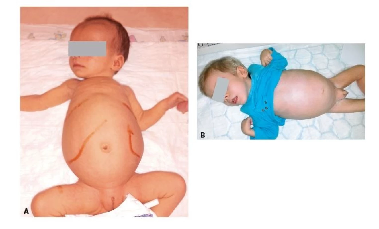 A. Objemná hepatosplenomegalie u 2měsíční dívky
s Niemannovou-Pickovou nemocí typu C.
B. Dystrofický 2letý chlapec s progredující hepatosplenomegalií
a jaterním selháním na podkladě
Niemannovy-Pickovy nemoci typu A/B.<br>
Fig 3. A. Extreme hepatosplenomegaly in 2-month-old child
with Niemann-Pick disease Type C.
B. Dystrophic 2-year-old boy with progressive hepatosplenomegaly
and liver failure based on Niemann-
-Pick disease Type A/B.