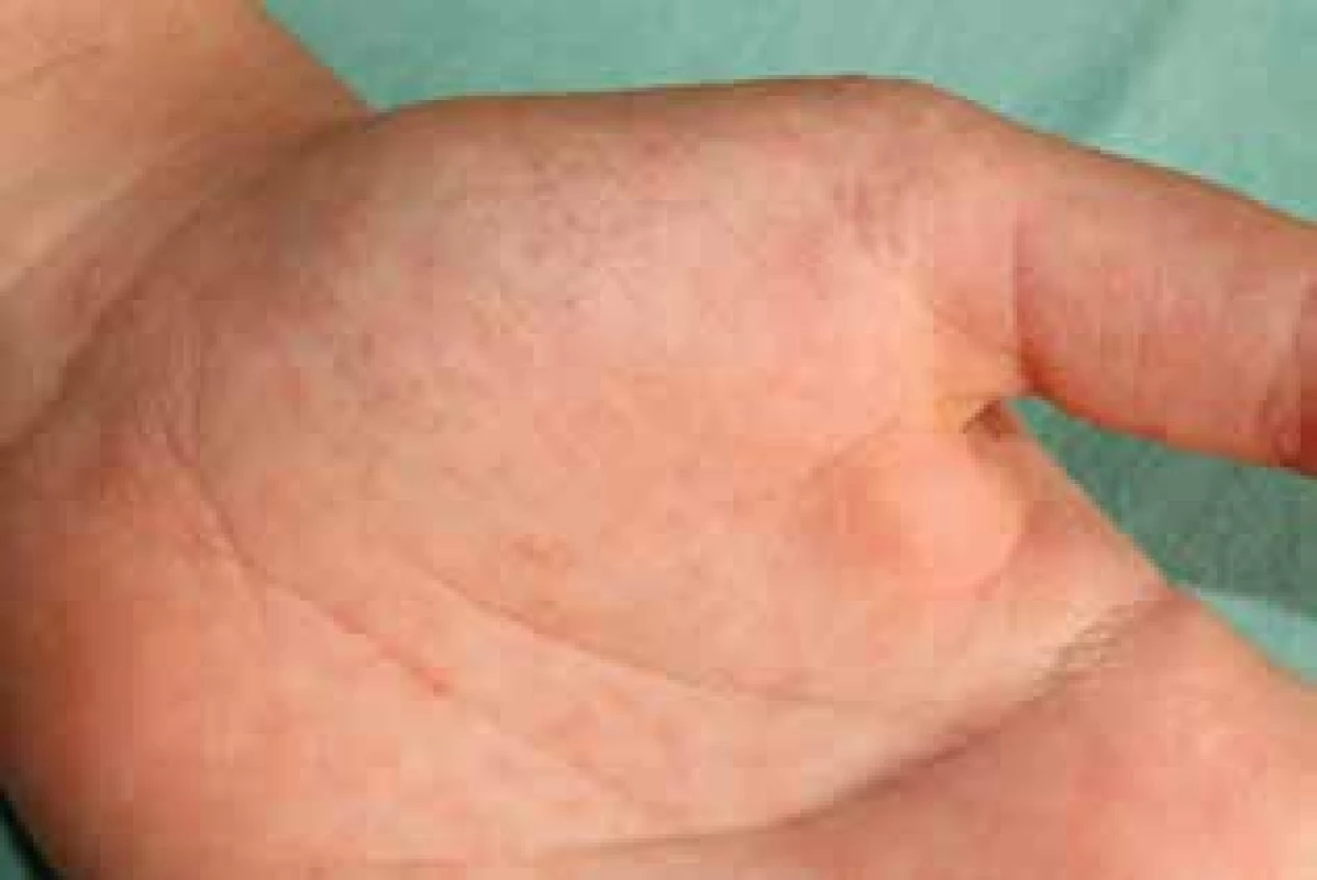 Typický výsev drobných punktátních keratóz na kůži dlaně