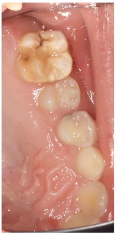 Hypomineralizovaný horní
molár s posteruptivní
frakturou<br>
Fig. 2
Hypominezalized upper
molar with posteruptive
fracture