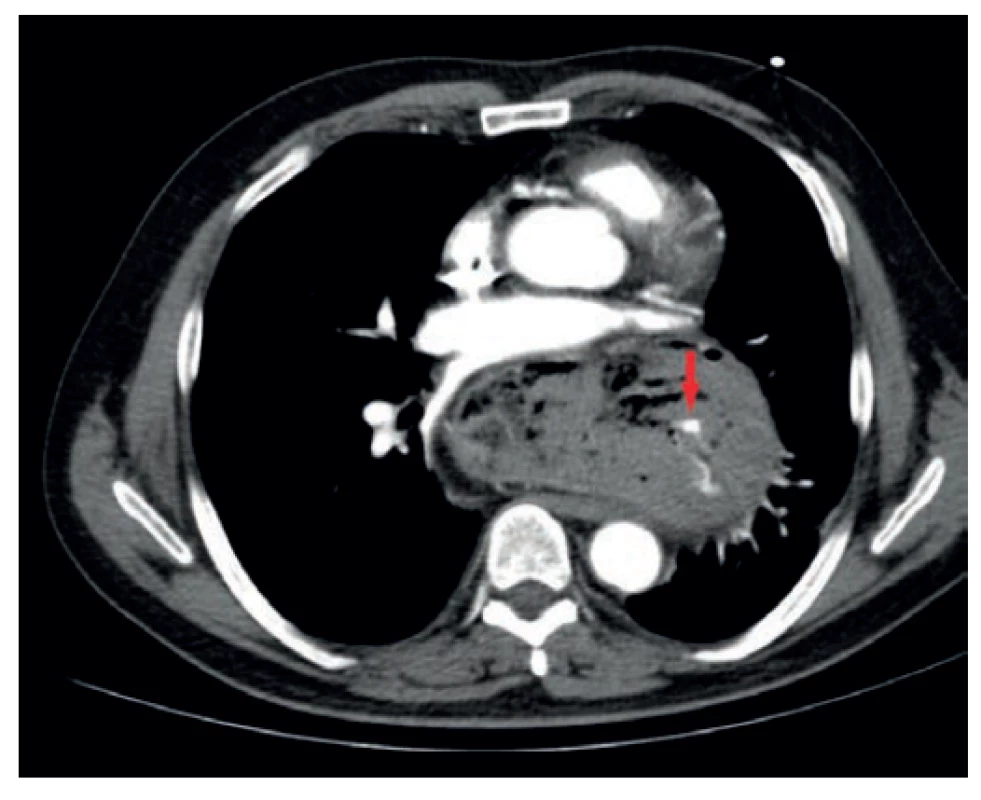 CT obraz aktivního krvácení ze žaludku herniovaného
do mediastina (upside-down stomach)<br>
Fig. 4. CT image of active bleeding from the stomach herniated
into the mediastinum (upside-down stomach)