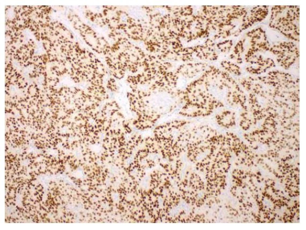 Kribriformní úprava nádorových struktur, imunohistochemicky
s průkazem silné exprese estrogenových receptorů (zvětšení 100x).