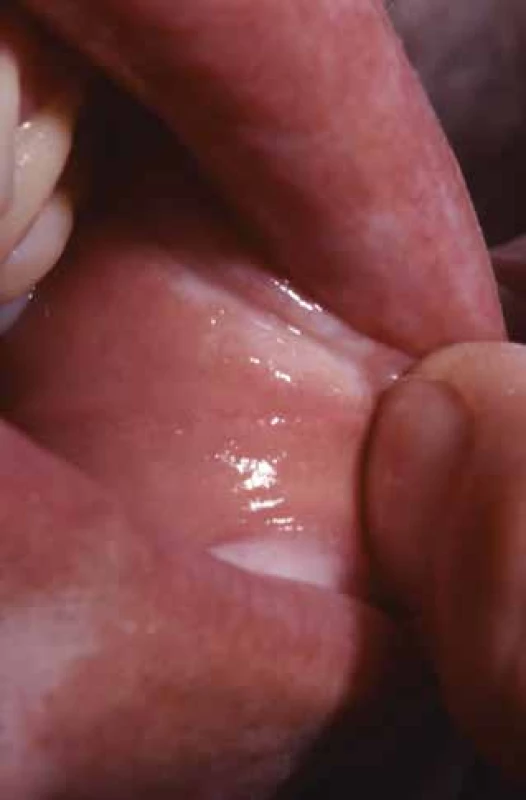 Bělavé okrsky LS na ústní sliznici