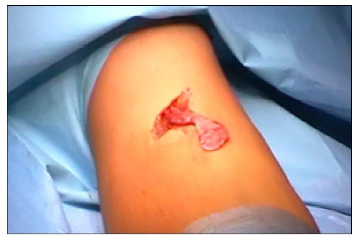 Kožní řez v kubitální jamce s vypreparovaným úponem dvojhlavého
svalu pažního