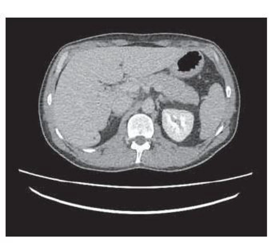 CT – hepatomegália, drobná
hypodenzná lézia do 3 mm v S6.<br>
Fig. 2. CT – hepatomegaly, small hypodense
lesion up to 3mm in S6.
