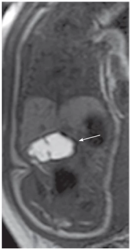 A 35-week-old fetus with colonic atresia. A coronal T1-weighted
Spin Echo (SE) sequence at 1.5T MRI shows subhepatic bowel
dilatation, hyperintense meconium signal in the intestinal lumen
(arrow).