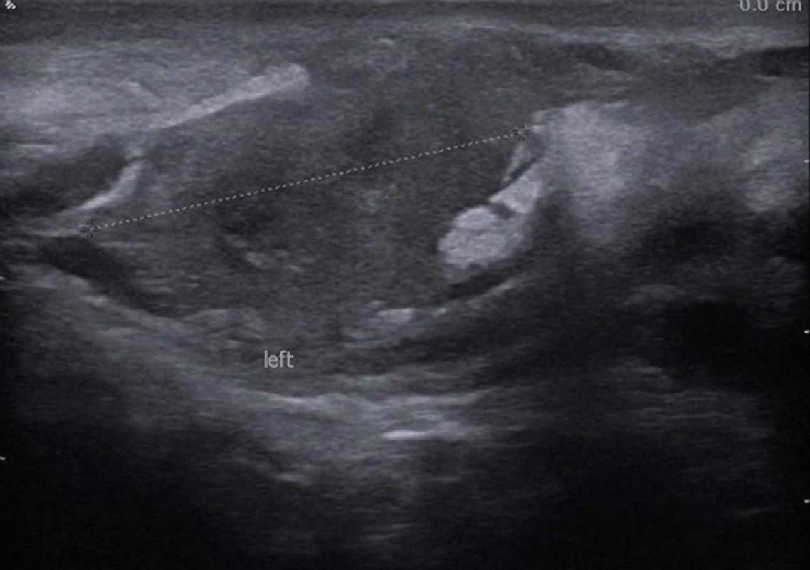 Ultrazvuk – eosinofilní funikulitida<br>
Fig. 1. Ultrasound – eosinophilic funiculitis