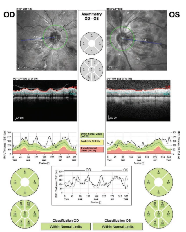 Optická koherenční tomografie - vrstva nervových vláken
pravého a levého oka - cirkulární lineární sken: Tloušťku vrstvy nervových
vláken nebylo možné zhodnotit pro vitreoretinální trakci, ložiskové změny
sítnice a nepřesné ohraničení vrstvy