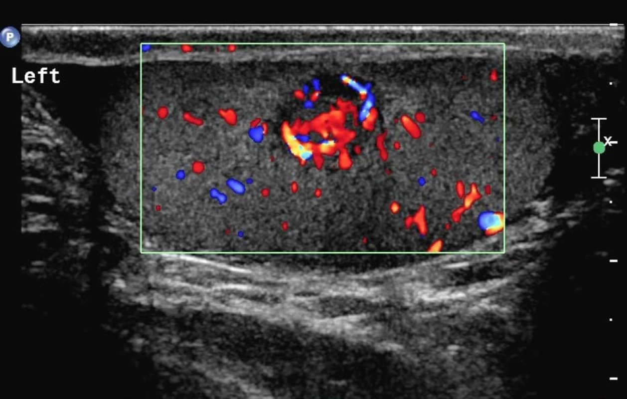 Duplexní ultrasonografie šourku: kuloidní ložisko levého varlete s hypoechogenní perfuzí<br>
Fig. 1. Duplex ultrasonography of the scrotum: orbicular focus of left testis with hypoechogenic perfusion