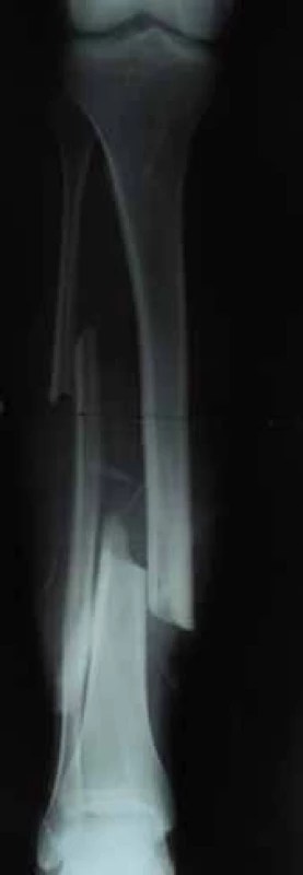 Trauma radiograph of
open tibial fracture