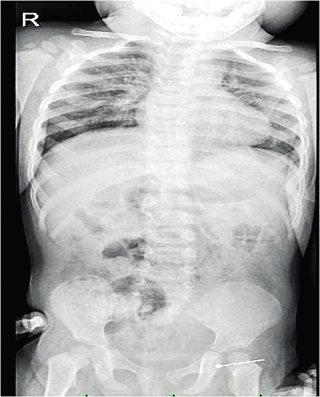 RTG celého GIT systému s nálezem špendlíku v oblasti tlustého střeva vlevo. <br><b>Fig. 8. </b> X-ray of the whole GIT with a pin finding in the colon area on the left side.
