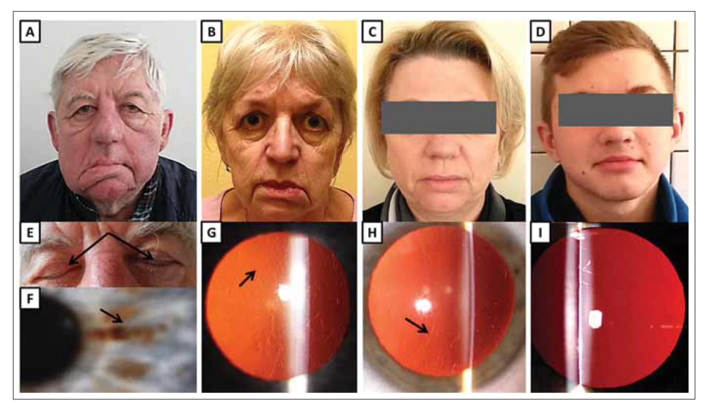 Klinické nálezy u jedinců s hereditární gelsolinovou amyloidózou z rodiny B.<br>
(A) Maskovitý vzhled obličeje 68letého muže (jedinec II:2) s ochablou kůží, povislými víčky a pokleslými koutky úst jako projev zjevné léze
n. facialis, která je obzvláště patrná na pravé straně.<br>
(B) 65letá žena (II:4) s ochablými očními víčky, pokleslými koutky úst a mírně odstávajícím dolním rtem, zejména vlevo.<br>
(C) 46letá žena (III:6) s povislou kůži v obličeji.<br>
(D) 14letý nositel patogenní mutace (IV:2) bez klinických projevů hereditární gelsolinové amyloidózy.<br>
(E) Lagoftalmus (šipky) u 68letého muže (II:2).<br>
(F) Rohovka stejného pacienta (II:2) s lineárními depozity (šipka).<br>
(G) Rohovka ženy (II:4) zobrazující lineární a větvící se depozita (šipka).<br>
(H) Rohovka ženy (III:6) zobrazující lineární a větvící se depozita (šipka).<br>
(I) Čirá rohovka asymptomatického muže (IV:2).<br>
Fig. 2. Clinical findings in subject with hereditary gelsolin amyloidosis from family B.<br>
(A) A 68-year-old male (II:2) with a mask-like facial appearance, cutis laxa, drooping eyelids and mouth as a result of obvious facial nerve
lesion, especially on the right side.<br>
(B) A 65-year-old female (II:4) with drooping eyelids, mouth corners and mild protrusion of her lower lip, which is more pronounced on the
left side.<br>
(C) A 46-year-old female (III:6) with drooping facial skin.<br>
(D) A 14-year-old male with pathogenic mutation (IV:2) without clinical signs of hereditary gelsolin amyloidosis.<br>
(E) Lagophthalmos (arrows) in a 68-year-old male (II:2).<br>
(F) Cornea of the same patient (II:2) containing linear deposits (arrow).<br>
(G) Cornea of female (II:4) showing linear branching deposits (arrow).<br>
(H) Cornea of female (III:6) showing linear branching deposits (arrow).<br>
(I) Clear cornea of asymptomatic male (IV:2).