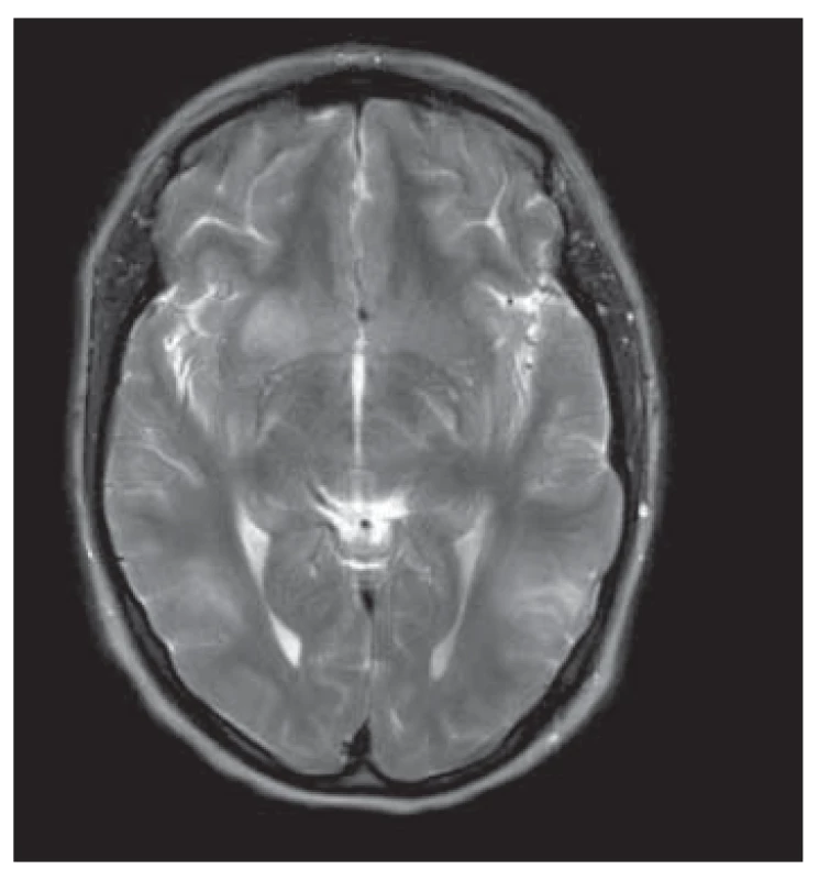 Nativní MR mozku u pacientky
s nálezem ischemických fokusů v oblasti
bazálních ganglií, v mozečku
a bilaterálně temporálně v souvislosti
s opakovanými atakami křečí v rámci
eklampsie (1. pooperační den).<br>
Fig. 1. Native brain MR findings in
a patient with ischemic foci in the
basal ganglia, cerebellum, and temporal
lobe bilaterally in the context of
repeated attacks of convulsions within
eclampsia (1st postoperative day).