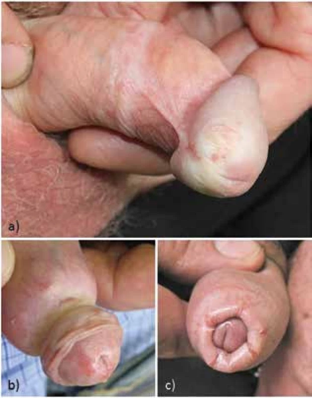 Bělavě prosáklý glans se zřaseným povrchem, zkrácené
frenulum, fibrotický cirkulární prstenec preputia (a), parafimóza
fibrotickým prstencem (b), fimóza pro zúžení preputia s ragádami
fragilního fibrotického preputia (c)