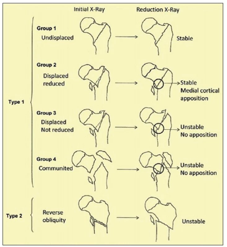 Evansova klasifikace trochanterických zlomenin