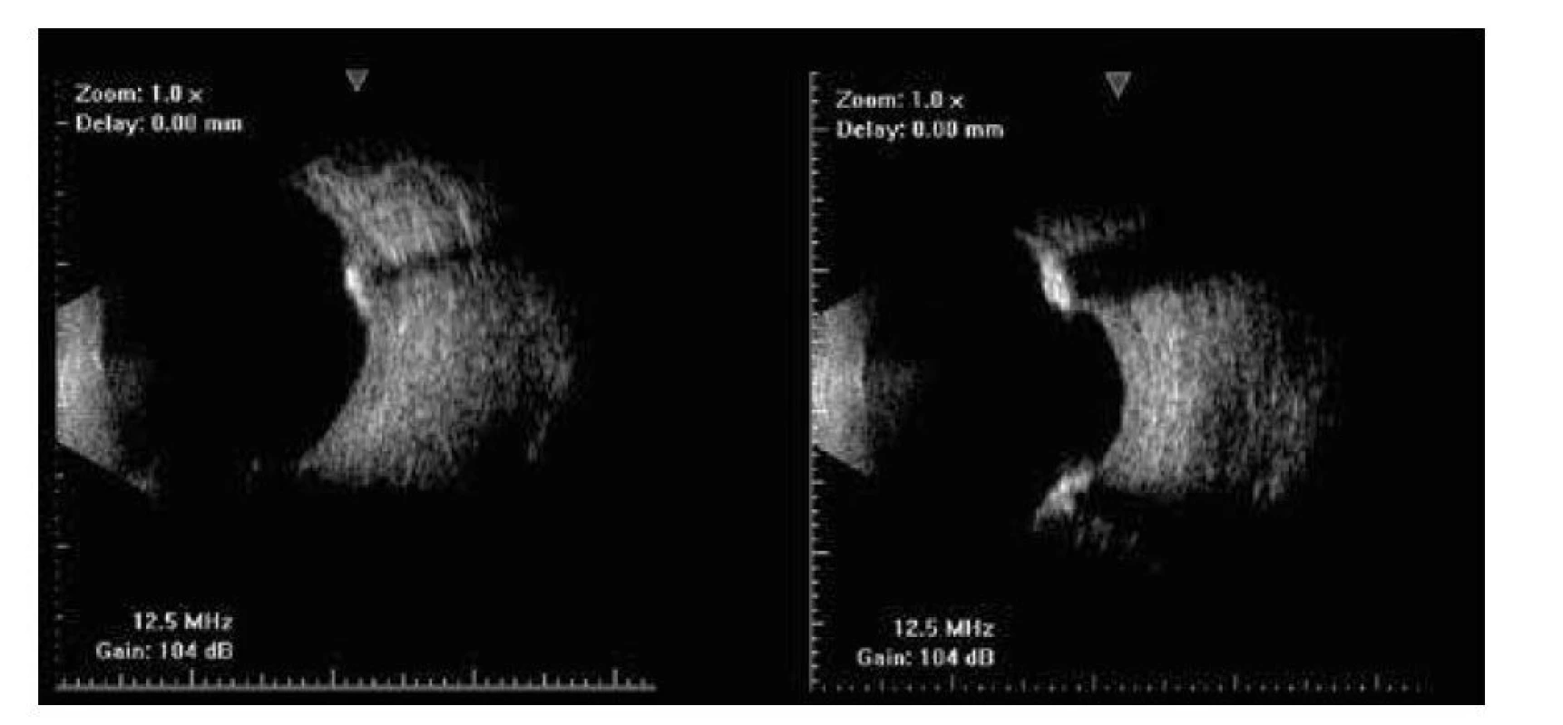 USG B-scan – bilaterálne početné drobné plakoidné hyperechogenity na úrovni sietnice,
ktoré prominujú mierne nad niveau