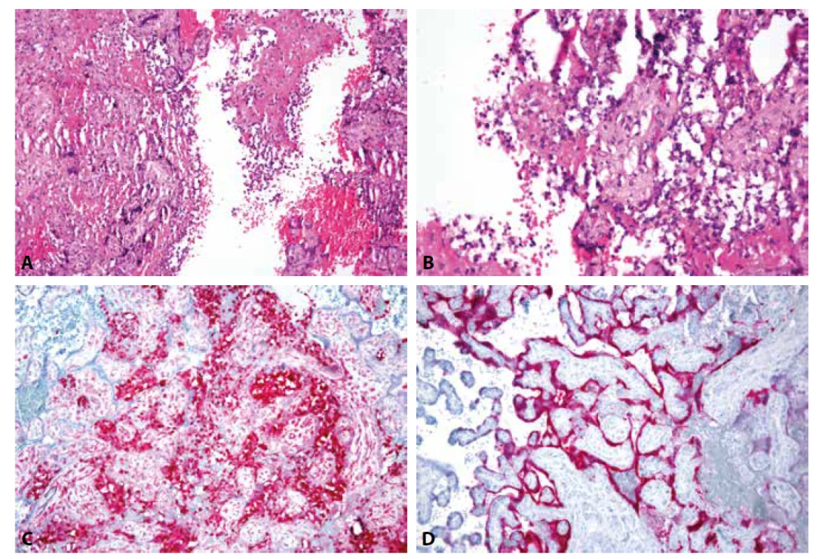 A: SARS-CoV-2 placentitida: Chronická histiocytární intervilositida s depozity perivilózního fibrinoidu a nekrózou vilózního trofoblastu (HE, 200x). <br>
B: Chronická zánětlivá celulizace s příměsí neutrofilních granulocytů v intervilózních prostorách, destrukce vilózního trofoblastu (HE, 400x).<br>
C: Imunohistochemický průkaz histiocytů v intervilózních prostorách (CD68, 200x). <br>
D: Imunohistochemický průkaz virového nukleokapsidového proteinu v cytoplazmě vilózního trofoblastu (SARS-CoV-2 BioSB, 200x).