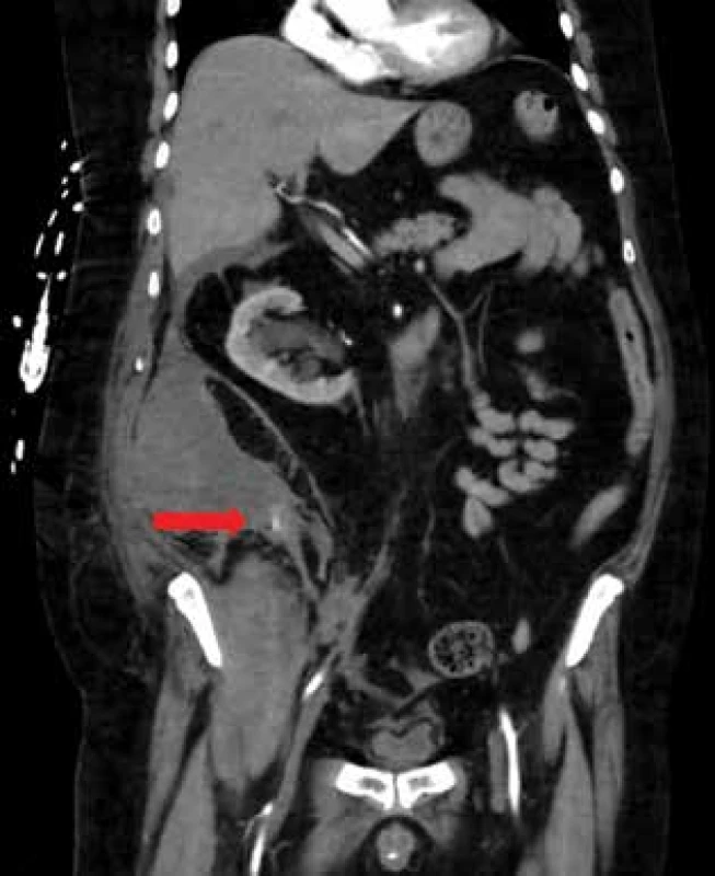 CT frontální řez: hematom retroperitonea vpravo
s viditelným krvácením v mediokaudální porci (označeno
šipkou)<br>
Fig. 1: CT (coronal scan): hematoma of the retroperitoneum
on the right with visible bleeding in the mediocaudal
part (indicated by an arrow)