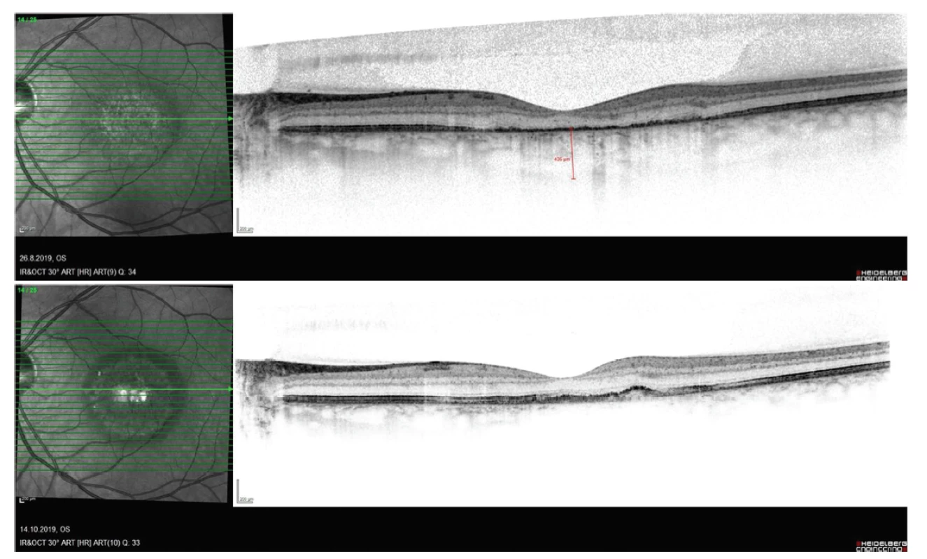 Postupný vývoj nálezu na snímku z optické koherenční tomografie u pacienta s chorioretinitidou, obnova reflexivity
retinálního pigmentového epitelu (RPE) (A), migrace buněk RPE centrálně (B)