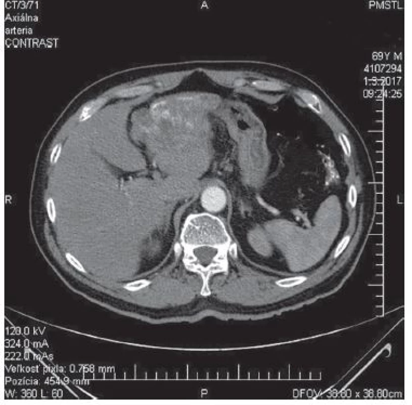 CT − arteriálna fáza, axiálny<br>
Fig. 1: CT − arterial phase, axial