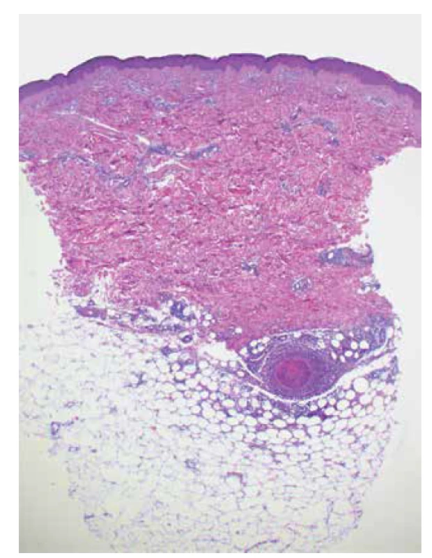 Nekrotizující vaskulitida středně velké arterie v podkožní
tukové tkáni u polyarteriitis nodosa (HE 25 x)