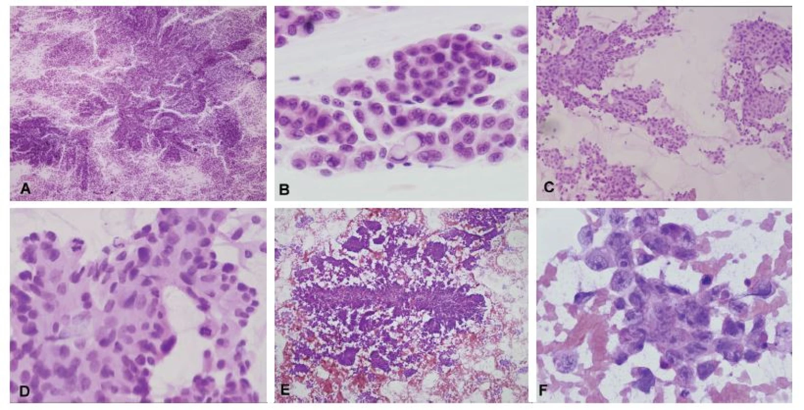 (A, B) Biopsia supratentoriálneho ložiska u 35-ročnej ženy. V náterovej cytológii boli zachytené papilárne formácie kohezívnych epiteloidných buniek
(A). V niektorých bunkách bola prítomná intracelulárna produkcia mucínu (B). Peroperačná diagnóza: metastáza adenokarcinómu. Definitívna diagnóza: metastáza
papilárneho adenokarcinómu pľúc. (C, D) Biopsia solitárneho ložiska u 63-ročného muža. V cytológii zachytené kohezívne plachtovité formácie epiteloidních
buniek. Ložiskovo naznačené glandulárne/acinárne štruktúry (C). Išlo o mierne atypické bunky s objemnou kolumnárnou cytoplazmou s početnými
mitózami (D). Peroperačná diagnóza: metastáza karcinómu, skôr adenokarcinómu. Definitívna diagnóza: metastáza acinárneho karcinómu prostaty. (E, F)
Biopsia supratentoriálneho ložiska u 19-ročného muža s anamnézou testikulárneho seminómu. V cytológii zachytené naznačene papilárne formácie epiteloidných
buniek (E). Jednalo sa o výrazne atypické bunky s prominentními jadierkami a svetlo eozinofilnou cytoplazmou (F). Peroperačná diagnóza: metastáza
epitelového nádoru, mohlo by sa jednať o germ-cell tumor. Definitívna diagnóza: metastáza embryonálneho karcinómu.