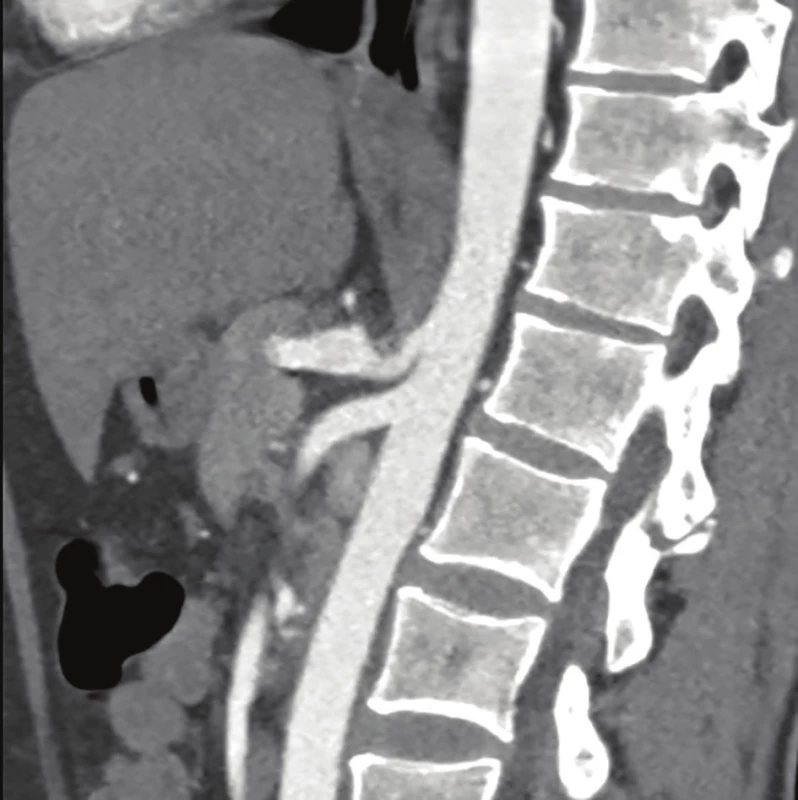 CT-angio nález kompresie truncus coeliacus<br>
Fig. 1: CT-angio celiac axis compression syndrome