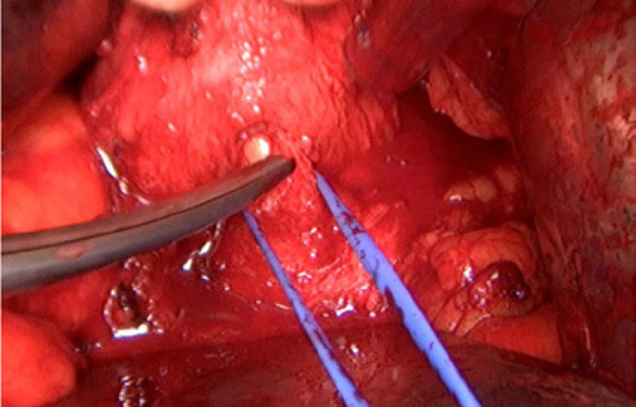Přerušena ventrální část prostatické uretry<br>
Fig. 5. Transection of the anterior portion of the
prostatic urethra