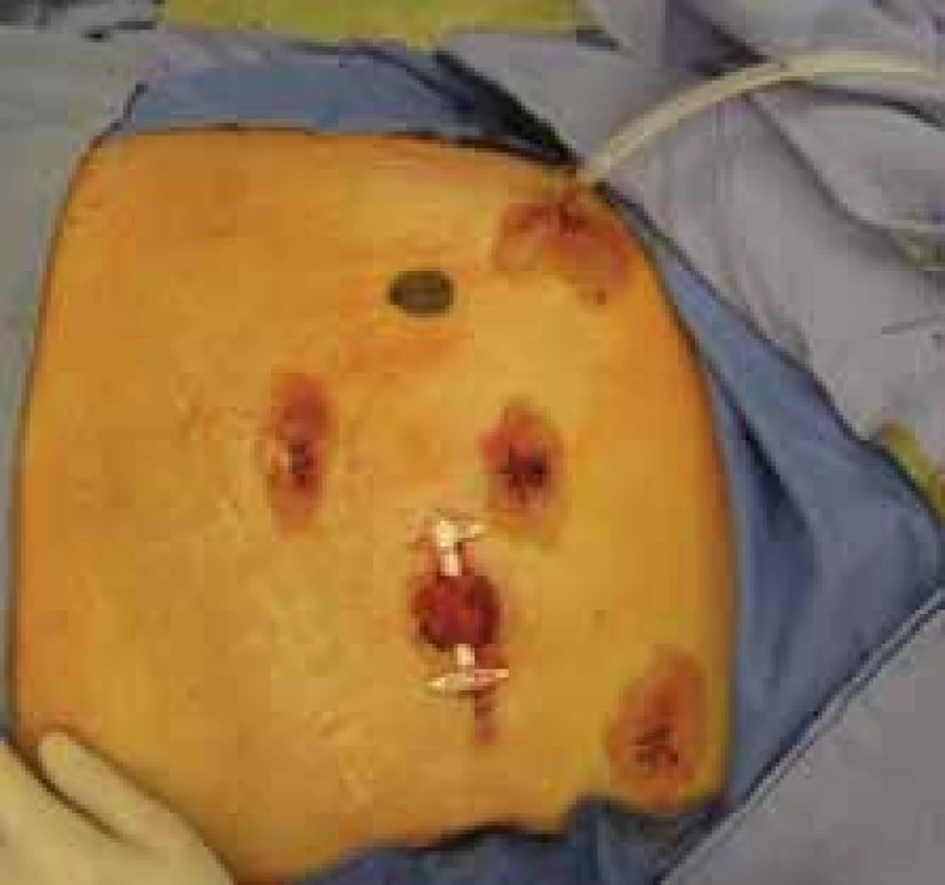 Výsledný stav po laparoskopické
a transanální resekci rekta pro nízko uložený tumor rekta s protektivní ileostomií.