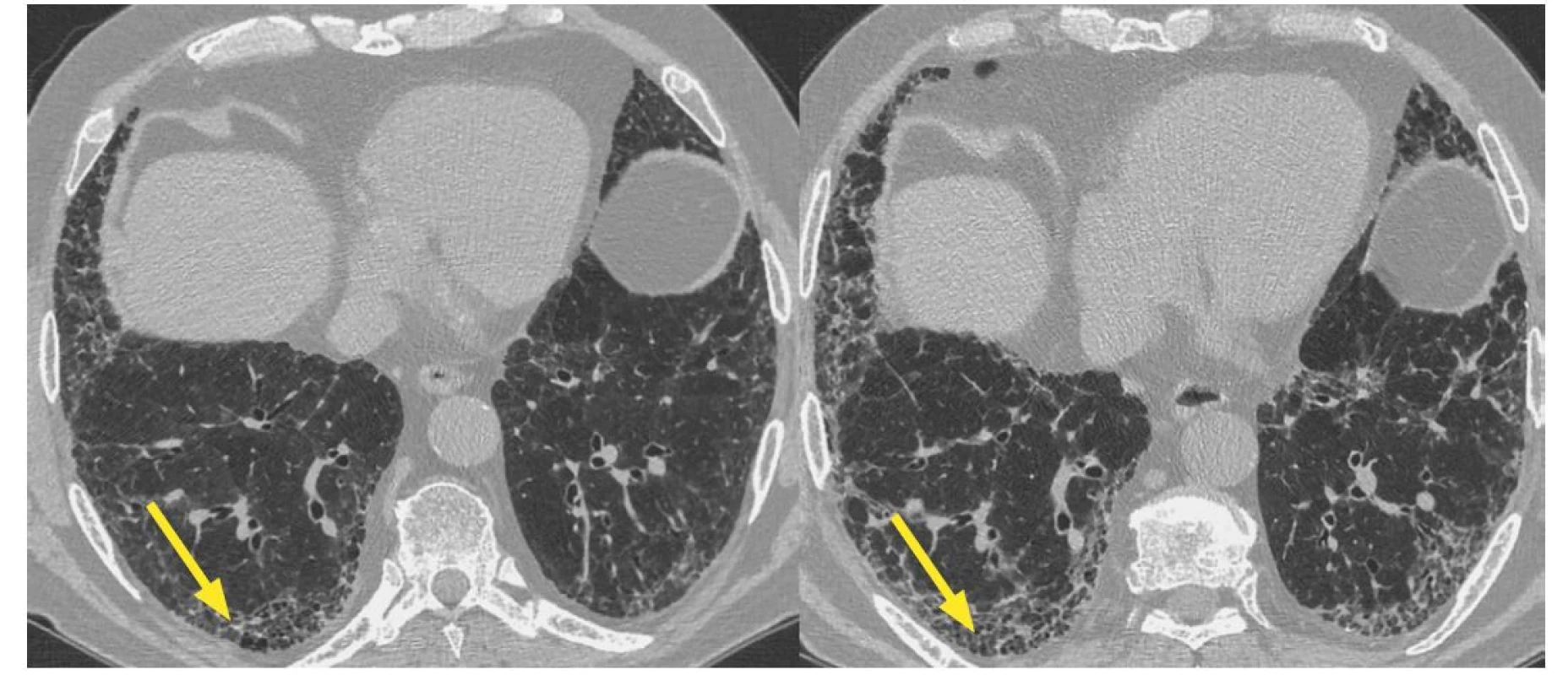 HRCT hrudníku s nálezem běžné intersticiální pneumonie u revmatoidní artritidy. Progrese plicní fibrózy v čase