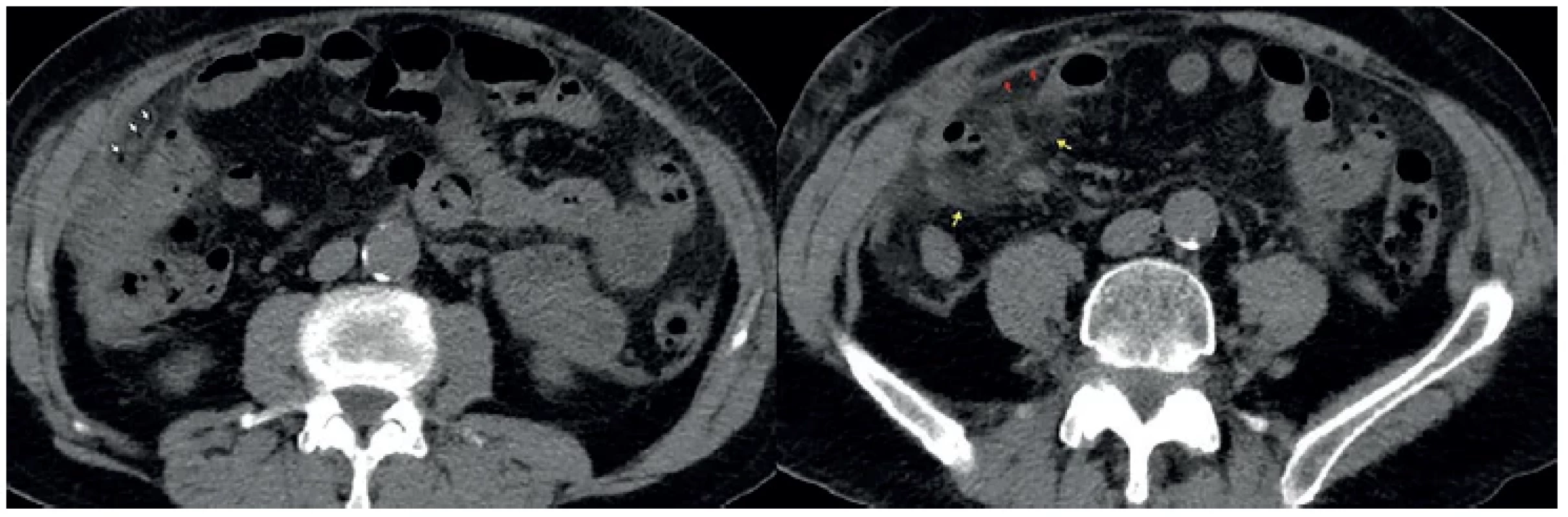 Divertikulitida ilea – CT břicha, nativně, axiální sken <br> 
Fig. 3. Diverticulitis of the ileum – CT scan of the abdomen, native, axial scan