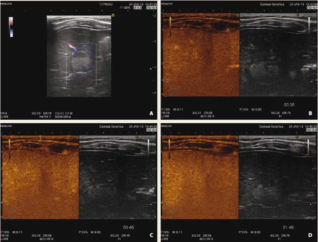 Fokální steatóza jater s využitím dopplerovského zobrazení (A), CEUS arteriální fáze (B), portální fáze (C),
pozdní fáze (D). Po podání kontrastní látky léze ve všech fázích splývá (je izoechogenní) s okolním
parenchymem jater.<br>
Fig. 2. Focal liver steatosis with use of doppler mode (A), CEUS arterial phase (B), portal phase (C), late phase (D).
After application of contrast agent, lesion is isoechogenic with surrounding liver parenchyma during all phases.