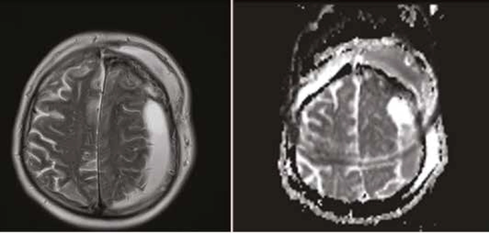 MR zobrazení subdurálního a subkutánního empyému po operaci mozkového nádoru –
závažná komplikace jako následek nekvalitně provedené rekonstrukce tvrdé pleny (A – T2 vážený
obraz, B – zdánlivý koeficient difuze, ADC)<br>
Fig. 2: MR imaging of subdural and subcutaneous empyema after cranial surgery – severe complication
as a result of insufficient dural reconstruction. (A – T2 weighted image, B – apparent
diffusion coefficient, ADC)
