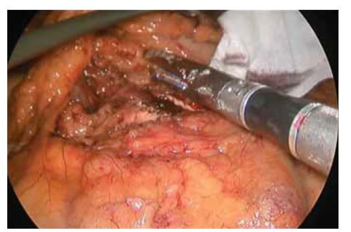 Přerušení pankreatu pomocí stapleru.<br>
Fig. 1. Stapler transection of the pancreas.