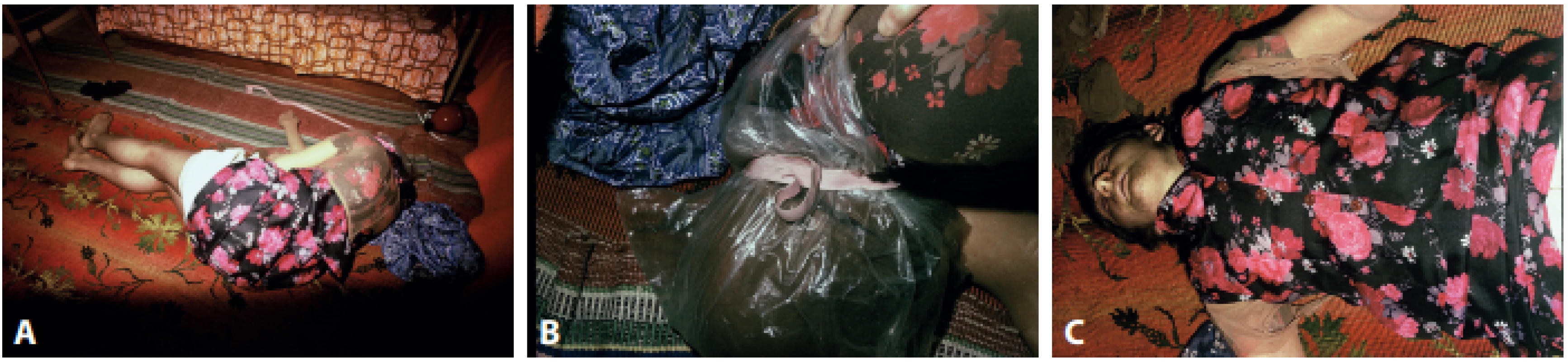 The body scene of 18-year-old young man. A: Position of the deceased at the death scene. B: A plastic bag wrapped around the head of the deceased
with a tape. C: The young man dressed in women´s clothing. 
