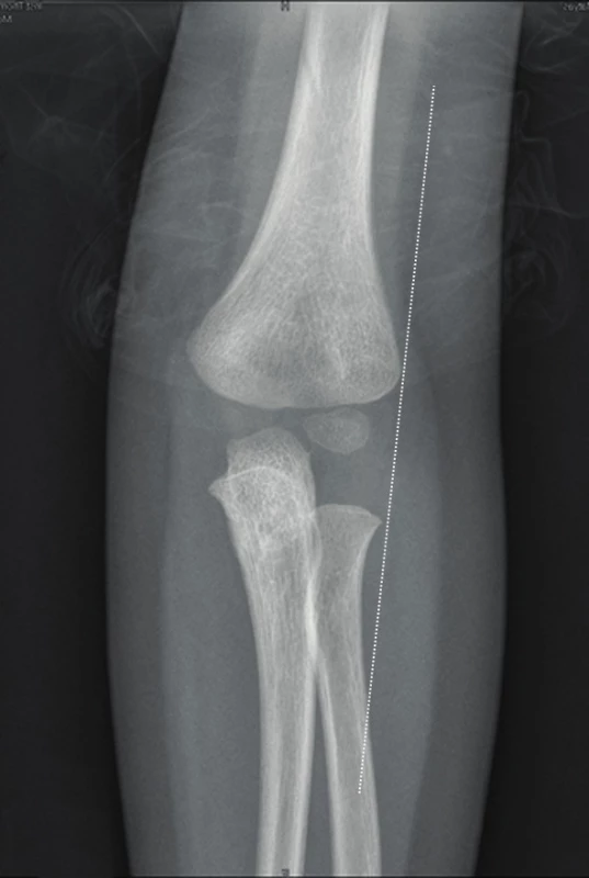 Healthy elbow joint, lateral humeral line miss the radial neck from the lateral side, boy, 3 years of age