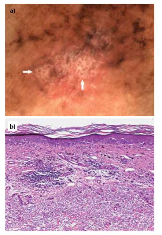 Pacientka, 72 let, lentigo maligna melanom (Breslow
0,2 mm) z dorzální strany levého předloktí<br>
a) dermatoskopický obraz s přítomností jasných bílých
proužků (šipky), zároveň jsou přítomny šedo-černé tečky
jakožto příznak regrese<br>
b) histopatologický obraz s vyjádřenými regresivními změnami
v podobě novotvořené fibrotizace a zánětlivým infiltrátem
sahajícím do hloubky 0,5 mm (HE, 100x).