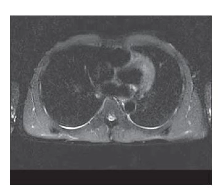 MRCP – diskrétny fluidotorax
bilaterálne (do 5 mm).<br>
Fig. 1. MRCP – discrete fluidothorax
bilaterally (up to 5 mm).