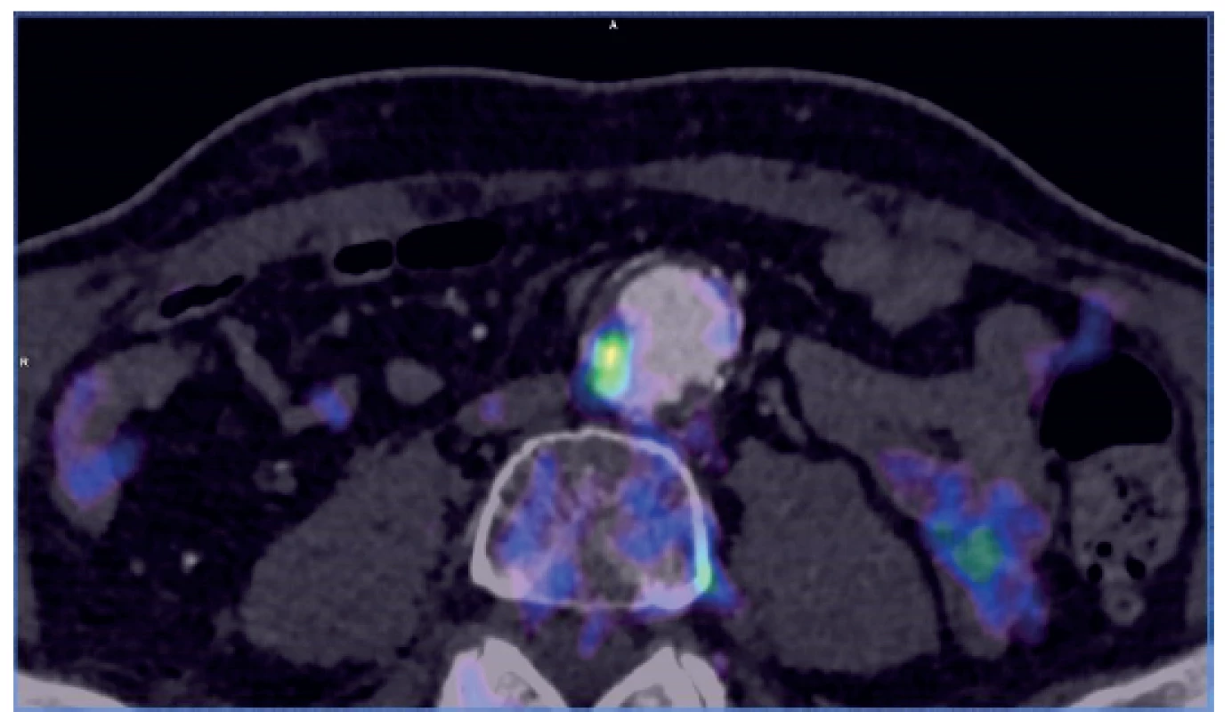 PET/CT – locally increased activity at the site of an
atherosclerotic plaque