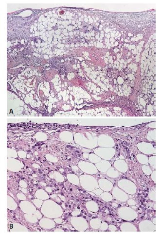 A: Infiltrace mezenteria diseminovaným nádorem s výraznou desmoplasií
ve stromatu (HE, 40x); B: Detail difuzně rostoucích nádorových
buněk bez zřetelného organoidního uspořádání (HE, 200x).