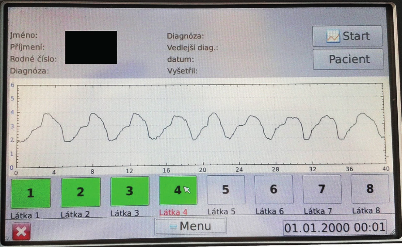 Zobrazení výsledku vyšetření na displeji přístroje.<br>
Pacient při klidovém dýchání dosahuje průměrných peaků inspiria
3,9V.