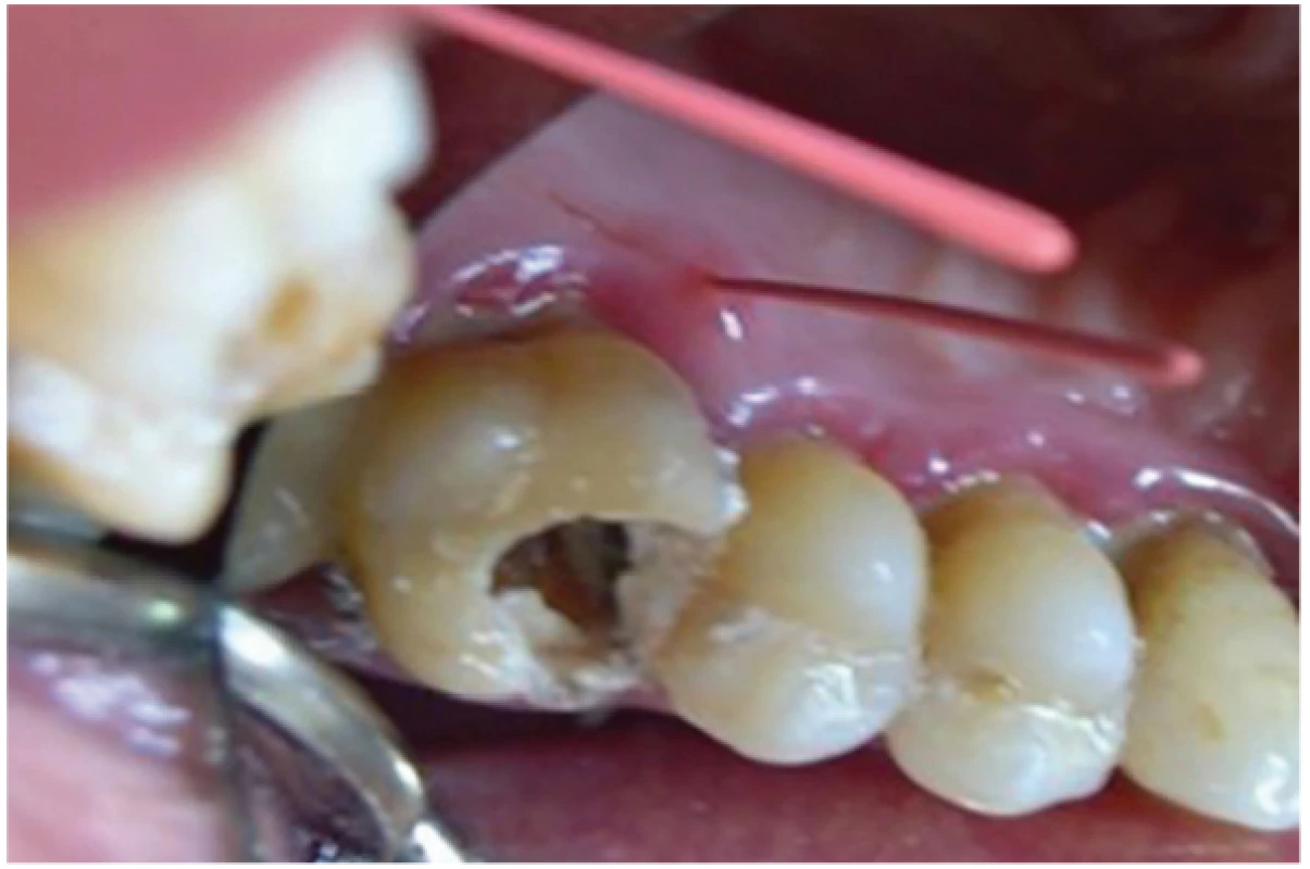 Intraorální fotografie zubu 16<br>
Fig. 6
Intra oral view on tooth 16