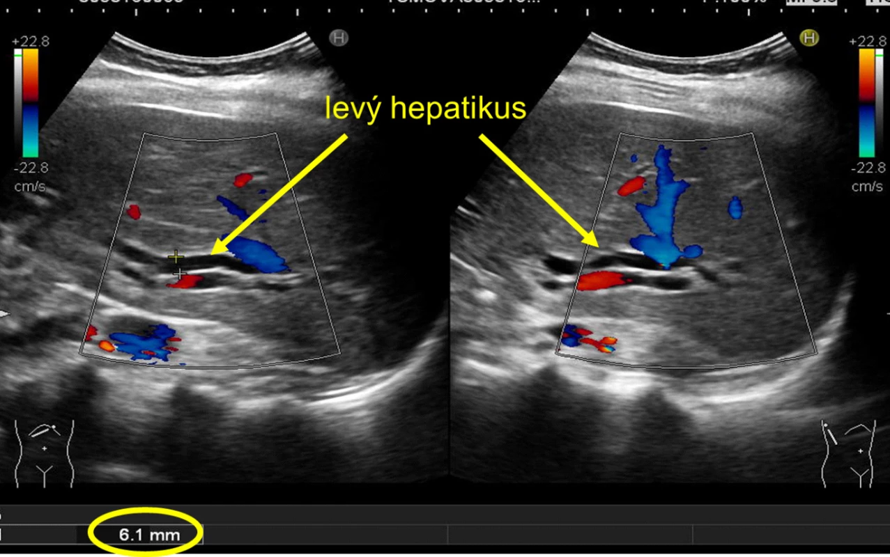 Dilatace hepatiků na UZ břicha<br>
Fig. 1: Dilation of hepatic ducts using abdominal ultrasound scan