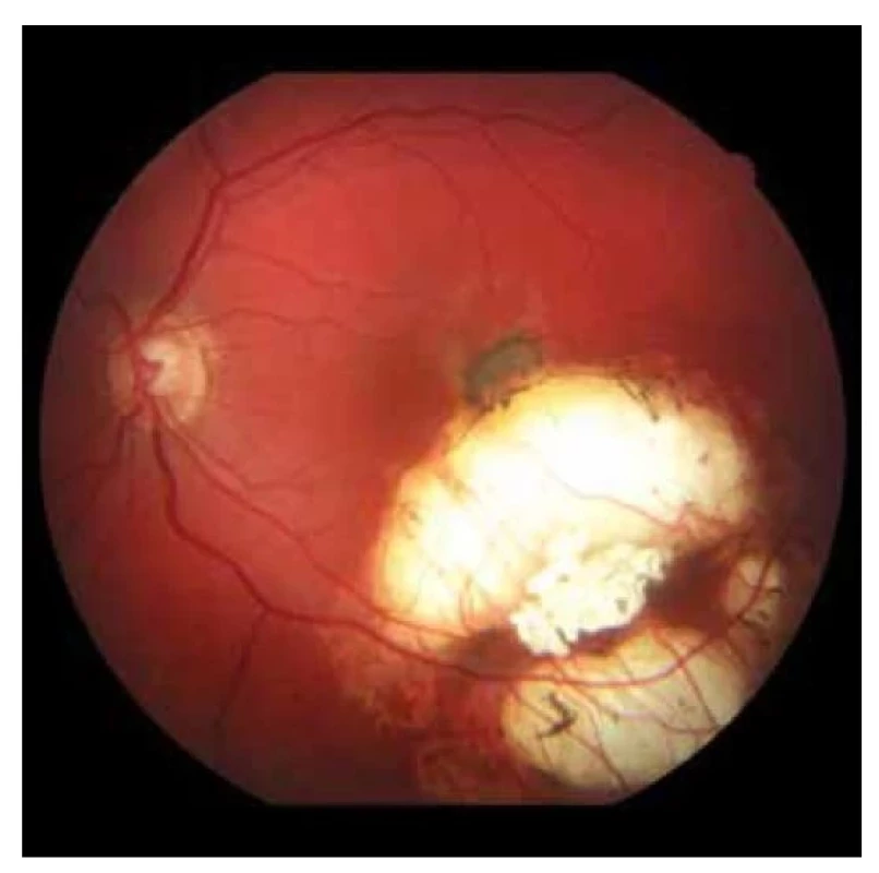 Fundoskopický nález na ľavom oku. Na okraji jazvy
v makule nasadajúca subretinálna neovaskularizácia (2019)